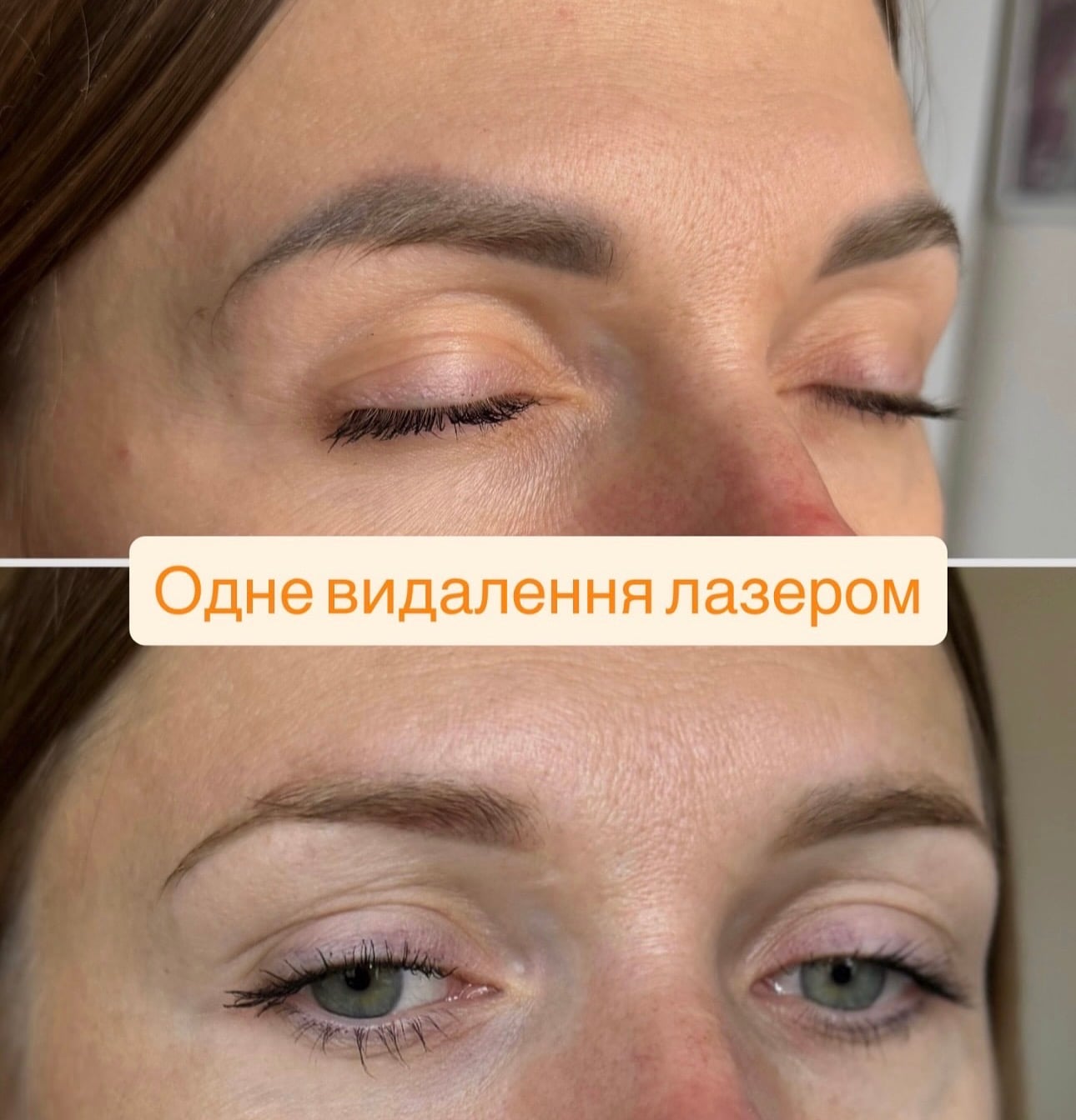 Лазерне видалення Безперечно, швидко , не потребує реабілітації, фото - Візажист Ірина