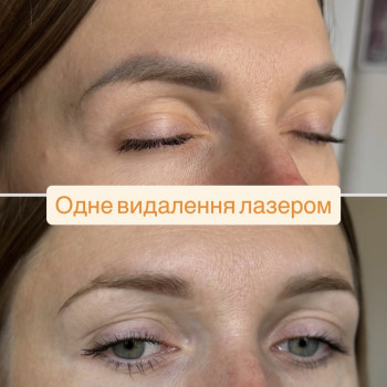 Лазерне видалення Безперечно, швидко , не потребує реабілітації