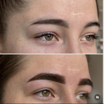 Перекриття брів без видалення