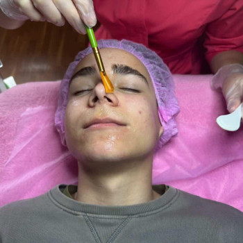 Догляд за підлітковою шкірою обличчя