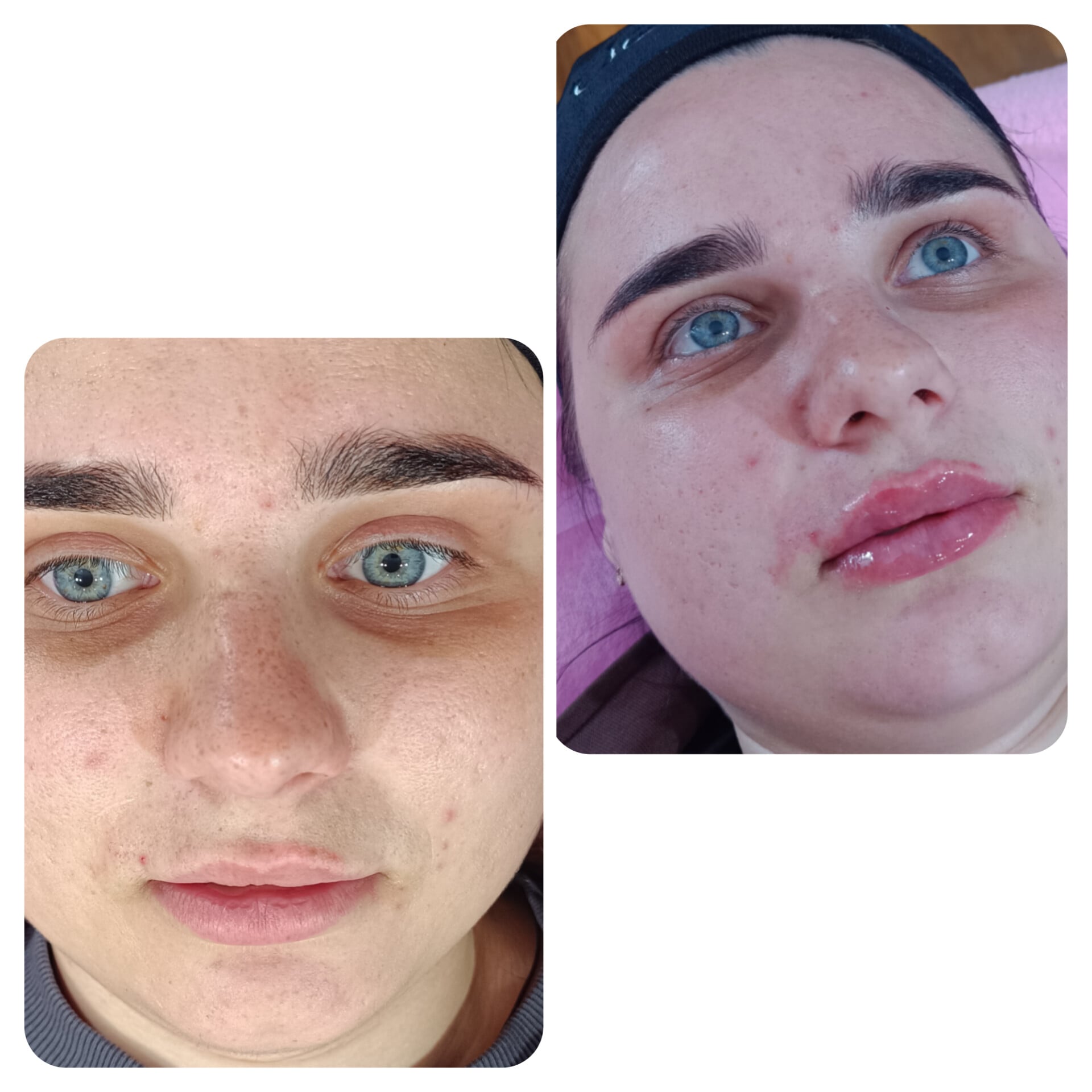 Збільшення Губ, фото - Косметолог-ін'єкціоніст Юлія Кучер