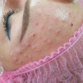 Біоревіталізація шкіри