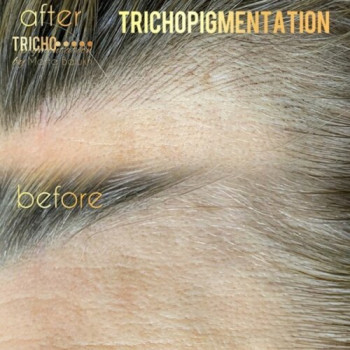 трихопігментаціяголови