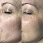 Мікростуми  для обличчя Косметолог-эстетист Людмила Харьков