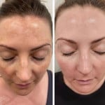 Мікронідлінг з екзосомами Косметолог-естетист Людмила Харків