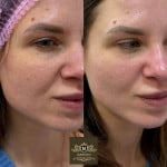 Пілінг для обличчя Дерматолог косметолог Нелли Київ