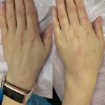 Полімолочна кислота для кистей рук Дерматолог косметолог Нелли Киев