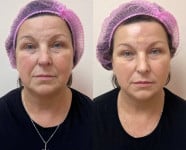 Плазма Гель омолодження Дерматолог косметолог Нелли Киев