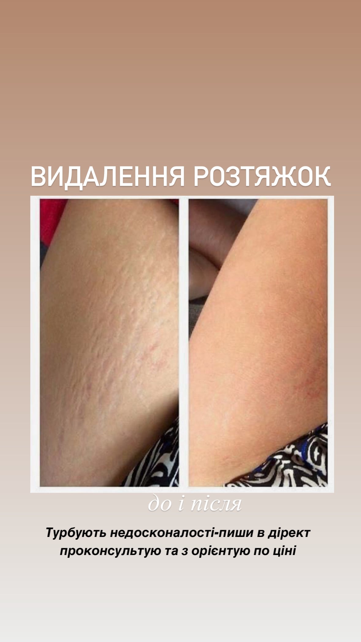 Каму камуфляж растяжек, фото - Мастер татуажа Ольга Леус