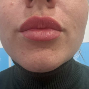 Загоєні губи з однієї процедури.Акварельна техніка губ