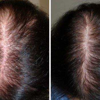 Фракційна мезотерапія волосся.Відновлення росту і густоти.