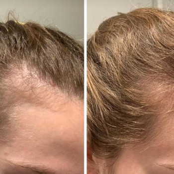 Лікування алопеції.Випадіння волосся