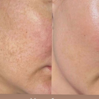 Фракційна мезотерапія.Відновлення шкіри обличчя,висвітлення пігментації