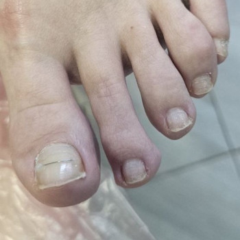 корекція врослого нігтя за допомогою титанової нитки