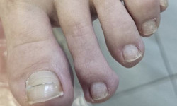 Корекция вросшего ногтя Салон краси Наоми Кривий Ріг