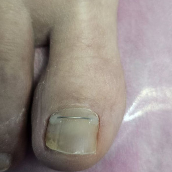 корекція врослого нігтя за допомогою титанової нитки