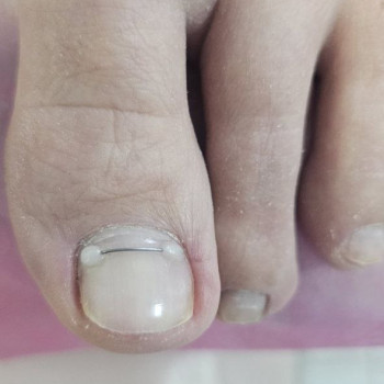 корекція врослого нігтя за допомогою титанової нитки