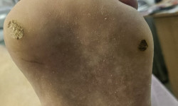 видалення мозолів Салон красоты Наоми Кривой Рог