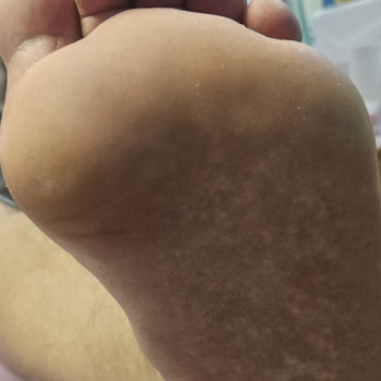 Видалення мозоля . Після процедури