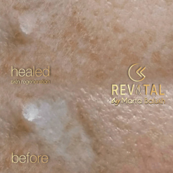 Перманентный макияж каму камуфляж шрамов, фото - Мастер татуажа Марта Балух