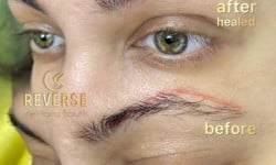 Видалення старого татуажу, невдалого перманенту ремувером Мастер татуажа Марта Львов