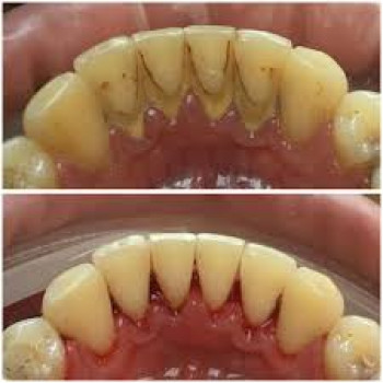 # зняття зубного каменю