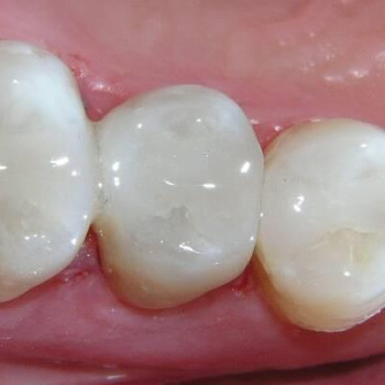 # церконієві коронки