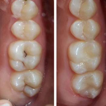 # Лікування карієсу