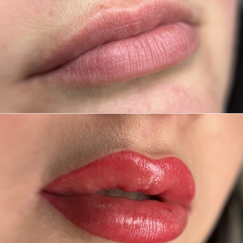 Губи до / після