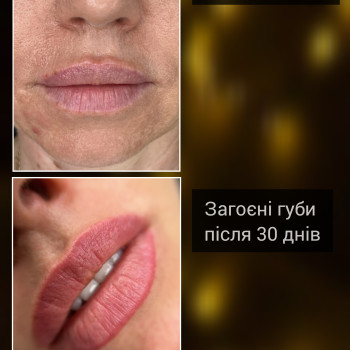 Губи до / загоєні губи