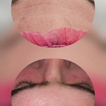 Карбоксітерапія