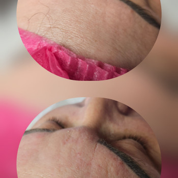 Чистка обличчя