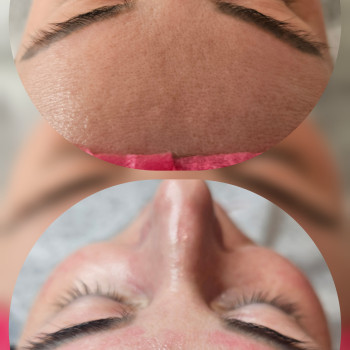 Чистка обличчя