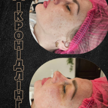 Мікронідлінг