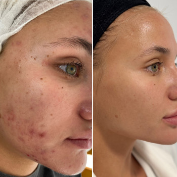 Лікування Акне