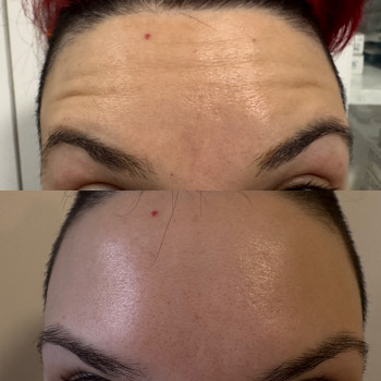 Ботулінотерапія