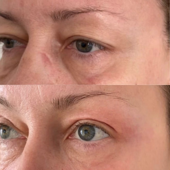 Блефаропластика без хірурга