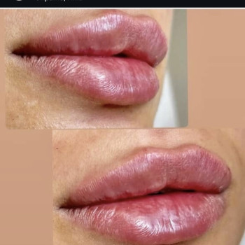 Збільшення Філер