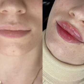 Збільшення губ. Філер.