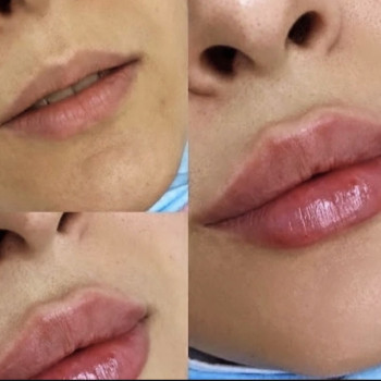 Збільшення губ