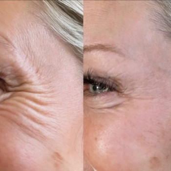 Навколо очей. Гусячі лапки