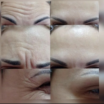 # ботокс # Міжбрівя Чоло Очі.