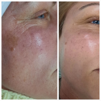 Виведення пігментації, зменшення глибини зморшок, ліфтинг обличчя.