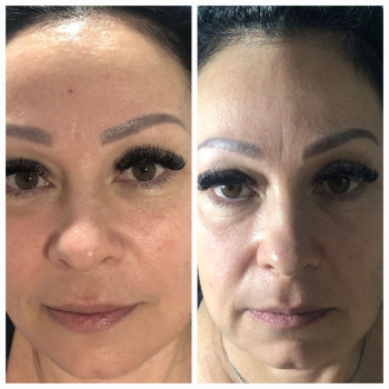 Ферментотерапія. Живлення, зволоження, освітлення, ліфтинг.