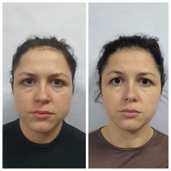 Масаж обличчя. Вирівнювання контура обличчя. Зняття зажимів.