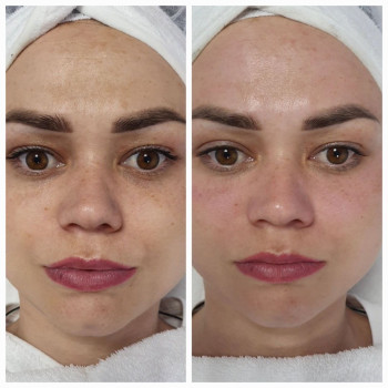 Комбінована чистка.