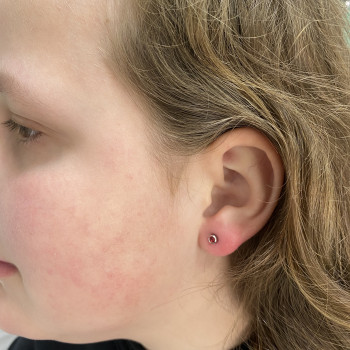 Прокол мочек ушей