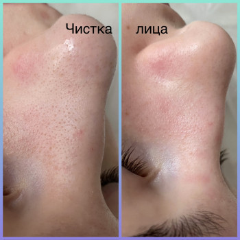 Механічна чистка лиця