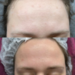 RF-ліфинг Лікар-косметолог Софія Львів