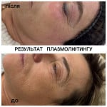 Плазмотерапія PRP / PRF отримай вигоду 300 грн Лікар-косметолог Юлія Луцьк